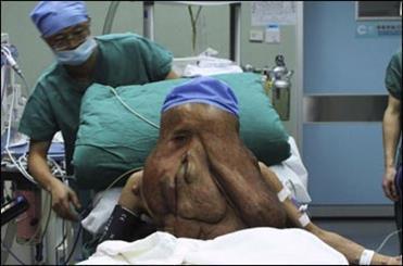 تصاویری از تومور 1.5 کیلویی روی صورت یک مرد، جراحی موفقیت آمیز مرد فیلی