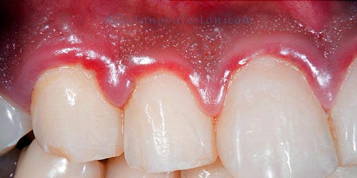 درمان عفونت های دندانی با طب سنتی