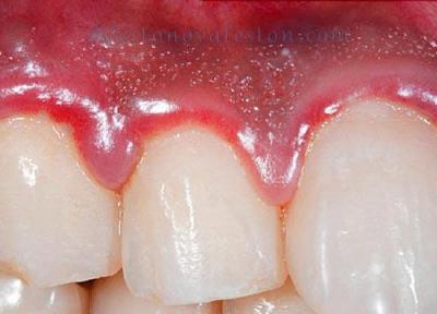 درمان عفونت های دندانی با طب سنتی